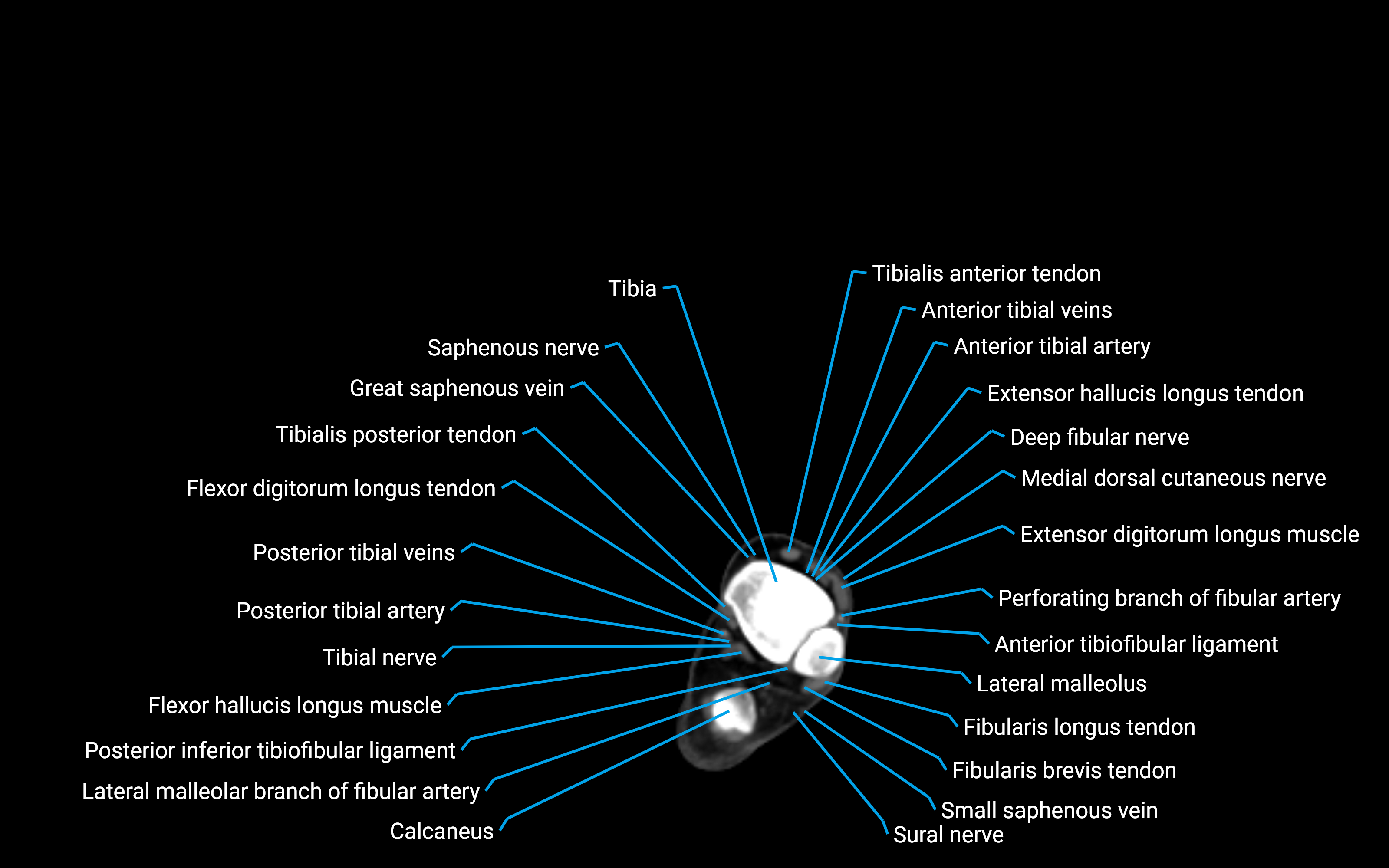 CT Lower leg axial cross sectional anatomy labelled image 165 (2).png